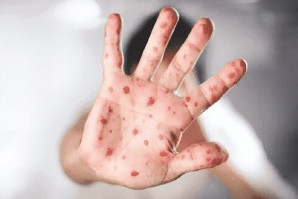آبله میمونی برای چه‌ افرادی خطرناک‌تر است؟