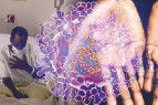 محققان هشدار می‏دهند؛ افراد HIV در معرض ابتلا به شدیدترین نوع آبله میمونی