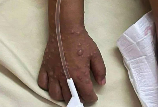 احتمال بازگشت آبله میمونی در تابستان وجود دارد