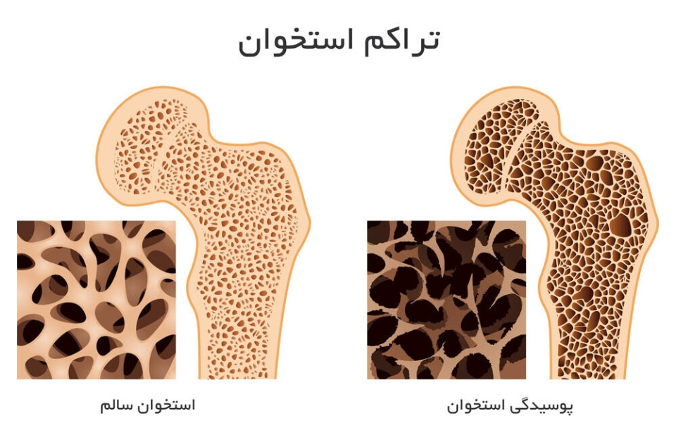 برای افزایش تراکم استخوان چه بخوریم؟