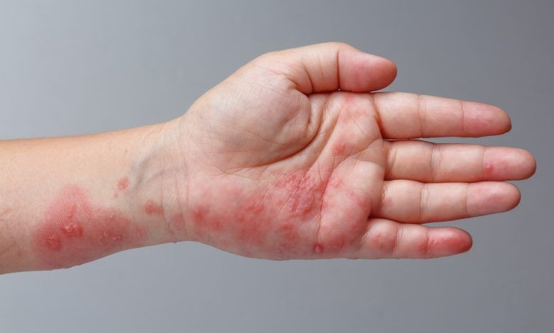 ویژگی‌های خاص واکسن زونا