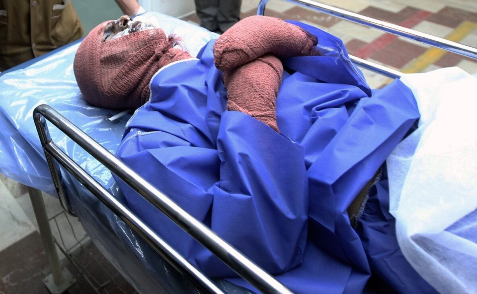 میزان سوختگی در ایران ۸ برابر میانگین جهانی