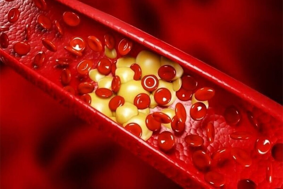 کلسترول بالا در جوانان؛ زنگ خطری که نباید نادیده گرفت